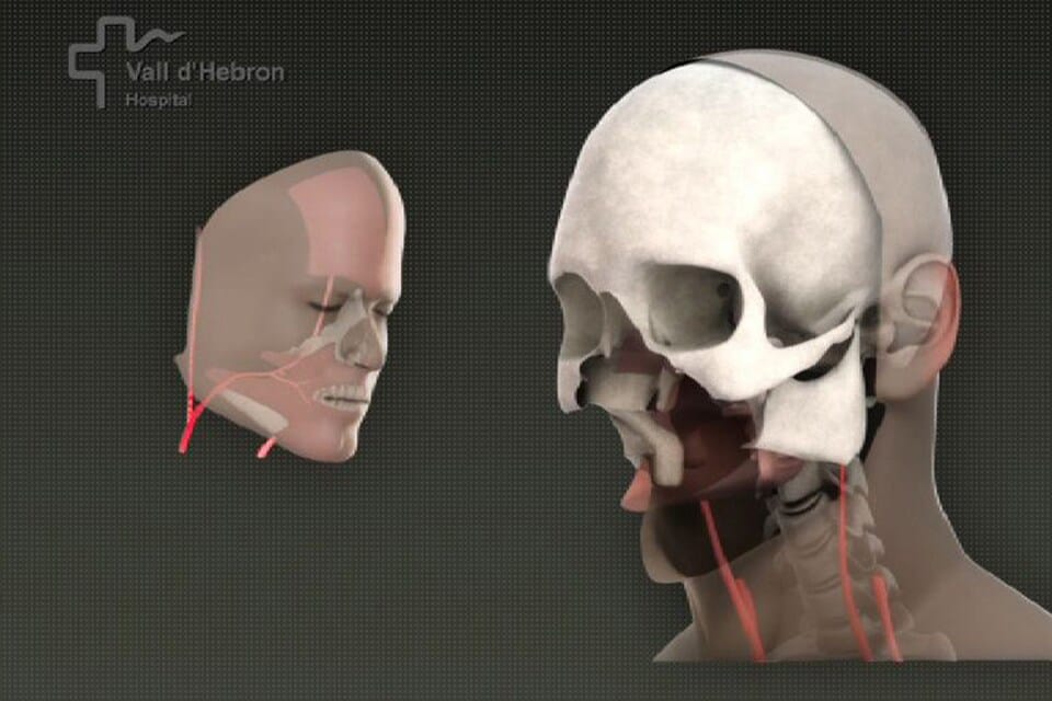 Computeranimatie van een gezichtstransplantatie